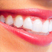 Ortodoncia Invisible en Badalona  Clínica Dental Ull-Dent (Badalona)